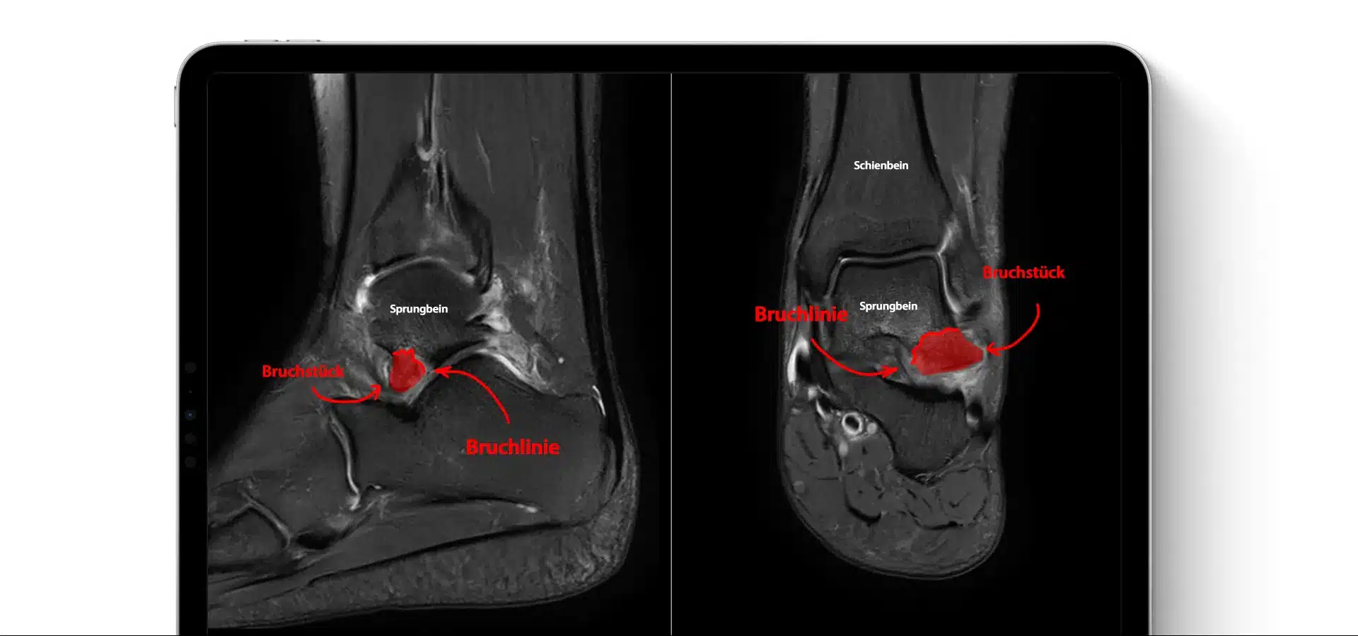 Darstellung eines Snowboarder's Ankle als typische Verletzung im MRT