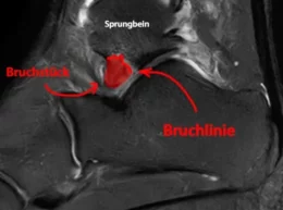 Snowboarder's Ankle